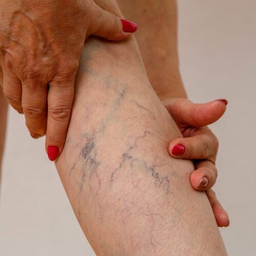 Vericose Veins Treatment at NIBM Road | Dr. Hina Khan
