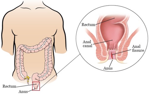 Fissures Treatment by Lady Proctologist in Pune, Dr. Hina Khan