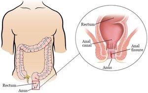 Fissures Treatment by Lady Proctologist in Pune, Dr. Hina Khan